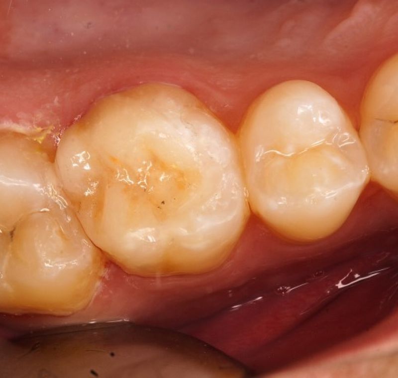 Restauración dental con e max